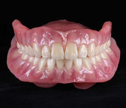 活动义齿修复病例 靖佳齿科技术中心 